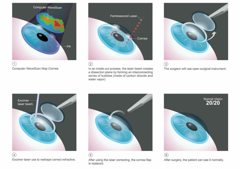 Ilasik Northampton Lasik Treatment Springfield Balin Eye